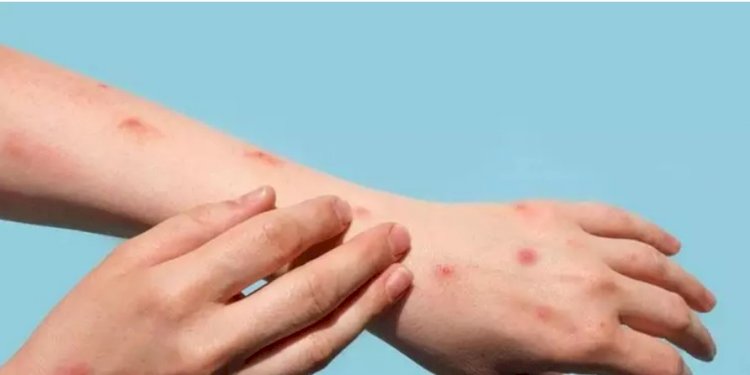 6 municípios de MT têm casos suspeitos da ' Monkeypox', (varíola do macaco).