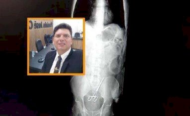 Tesoura é 'esquecida' dentro do corpo de vereador de MT após cirurgia
